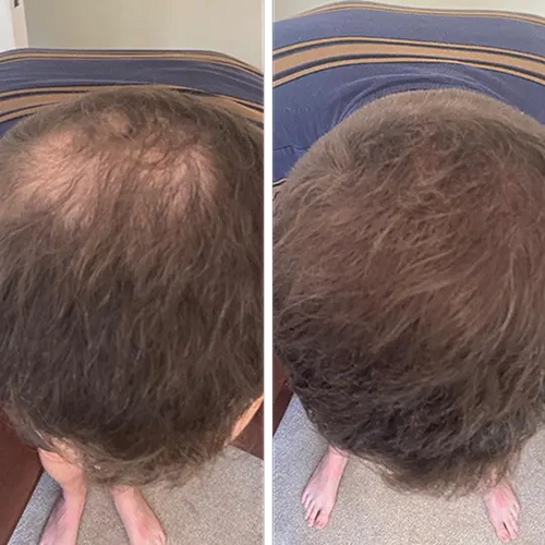 5 Best Hair Growth Products of 2026 & Why Dermatologists Say Many Don’t Deliver